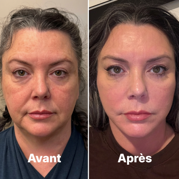 Brosse Lymphatique Elvra