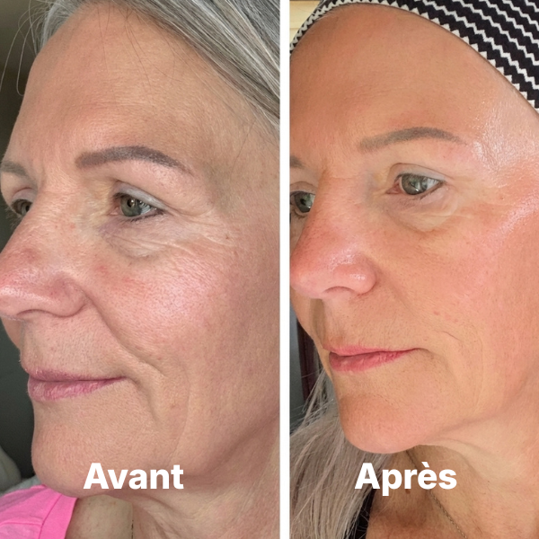 Brosse Lymphatique Elvra